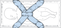 StatStrapNeonatalPositioning Strap